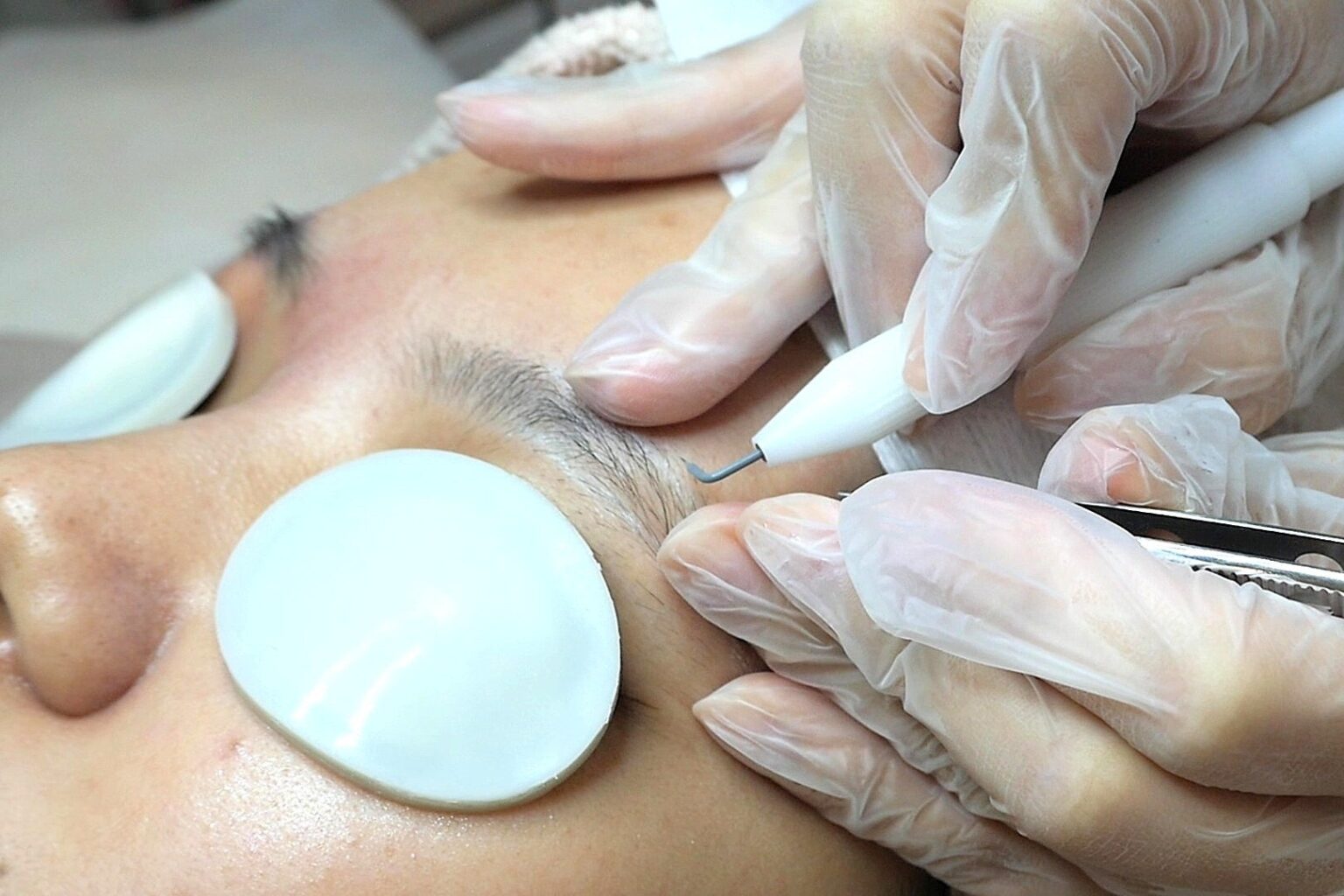 リゼクリニックのニードル脱毛導入1年 白髪・硬毛化対応で需要拡大、お笑いコンビ「かまいたち」が体験動画